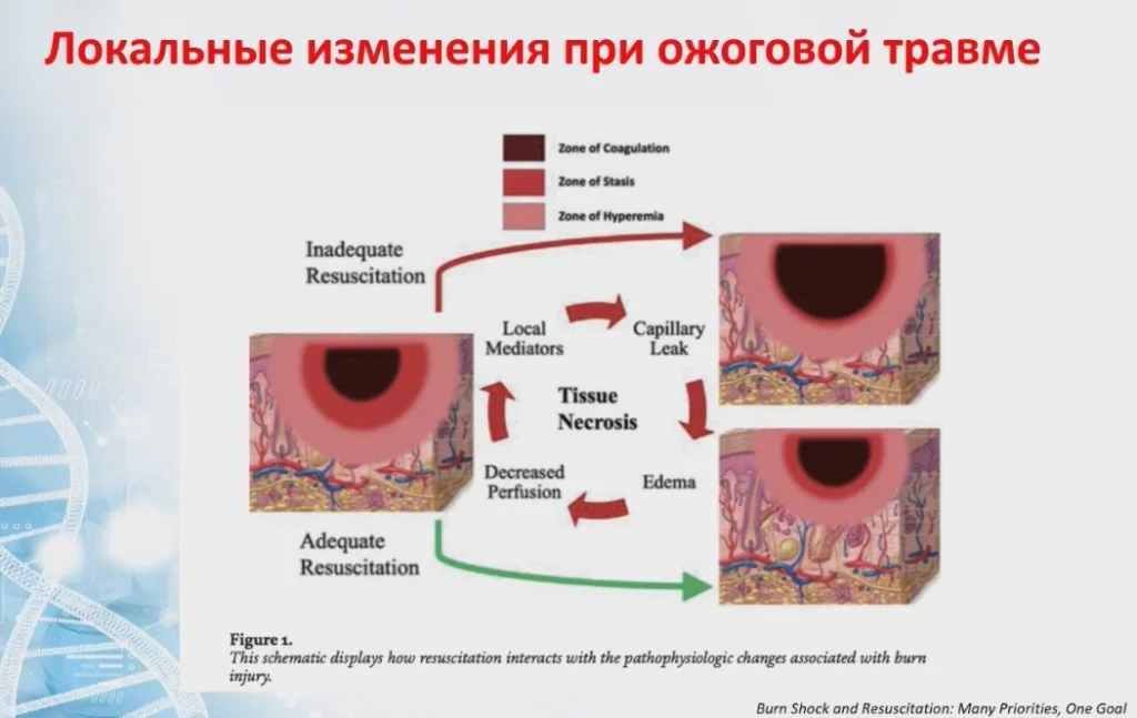 Локальные изменения при ожоговой травме.jpg