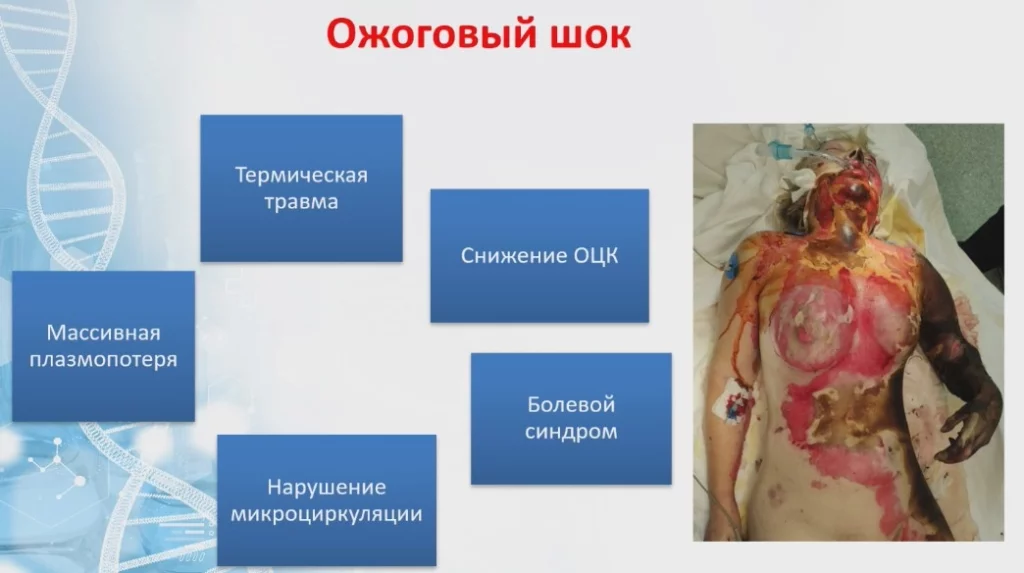 Ожоговый шок.jpg